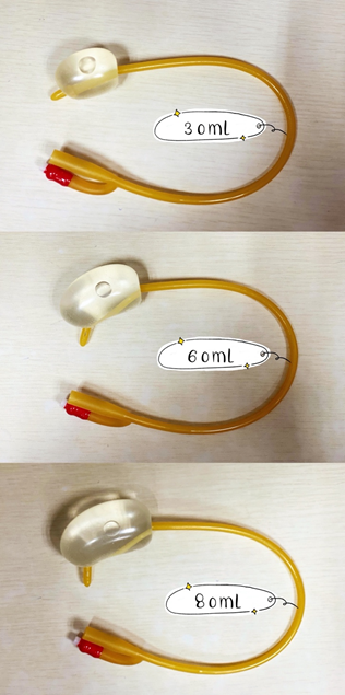 导尿管上fr是什么意思导尿管可不止用来导尿，这些用途，你可能还不知道_https://www.jmylbn.com_新闻资讯_第7张