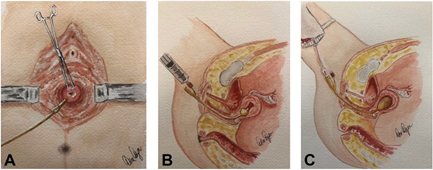 导尿管上fr是什么意思导尿管可不止用来导尿，这些用途，你可能还不知道_https://www.jmylbn.com_新闻资讯_第5张