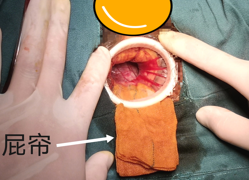 为什么不用切口保护套龚瑶专栏 ｜ 切口保护套在腹腔镜术中的 5 大妙用_https://www.jmylbn.com_新闻资讯_第5张