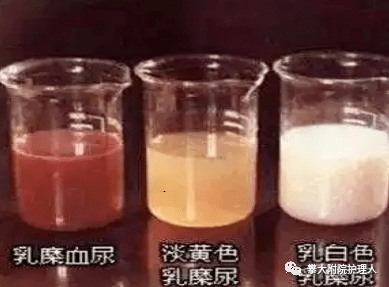 弯头导尿管怎么用小小尿管作用大，自行拔出危害大！_https://www.jmylbn.com_新闻资讯_第31张