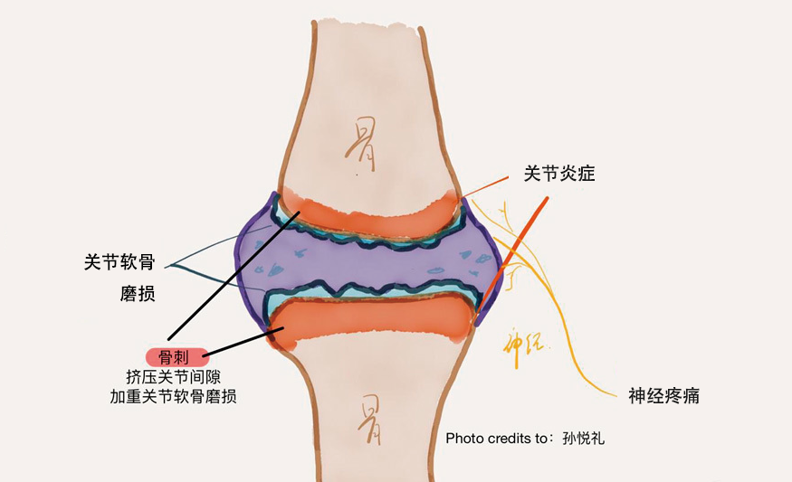 骨刺一般长在什么地方