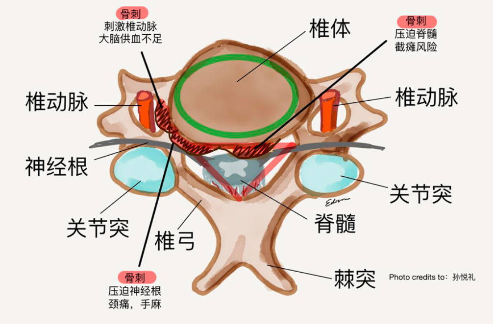 骨刺一般长在什么地方