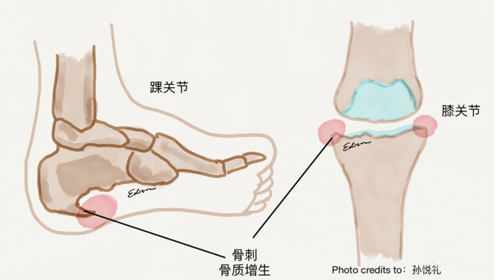 骨刺一般长在什么地方