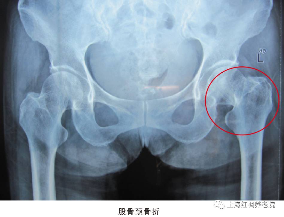 冬天谨防老人意外骨折
