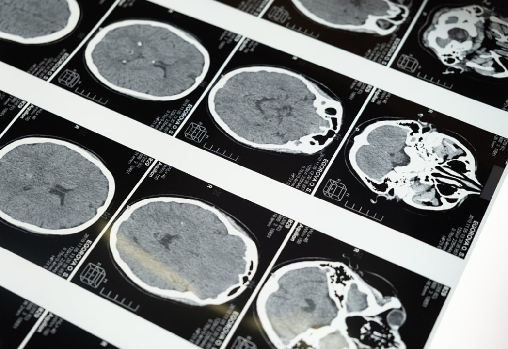 给孩子做ct,辐射到底有多大?