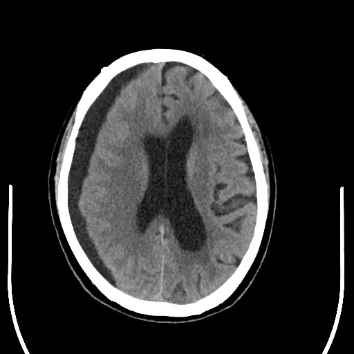 左侧下肢无力,头部ct提示硬膜下积液01出院后随访术后颅脑ct复查术