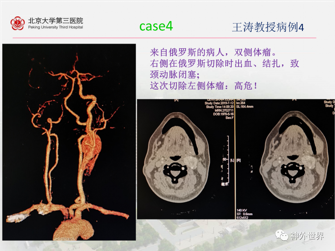 北京大学第三医院王涛教授颈动脉体瘤的外科治疗