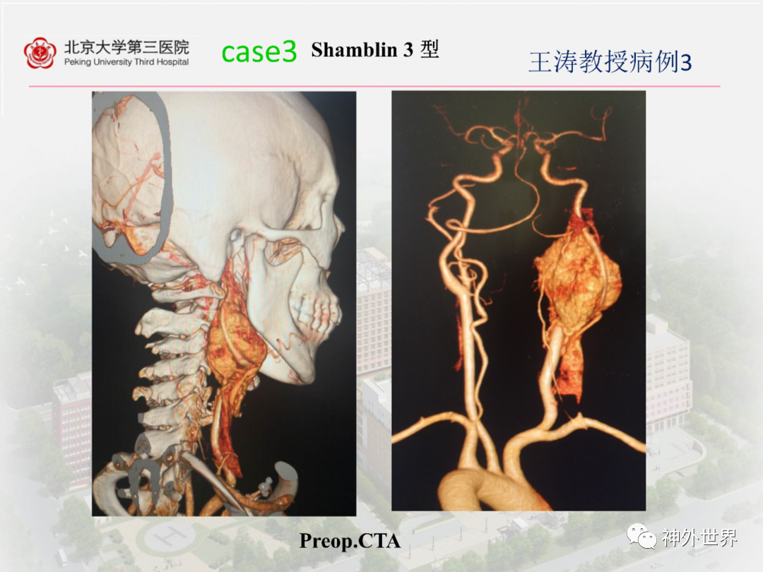 颈动脉体瘤位置图片图片