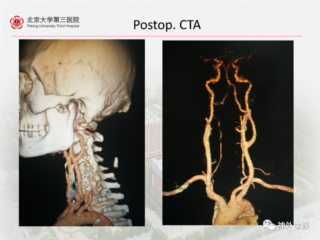 颈动脉体瘤位置图片图片