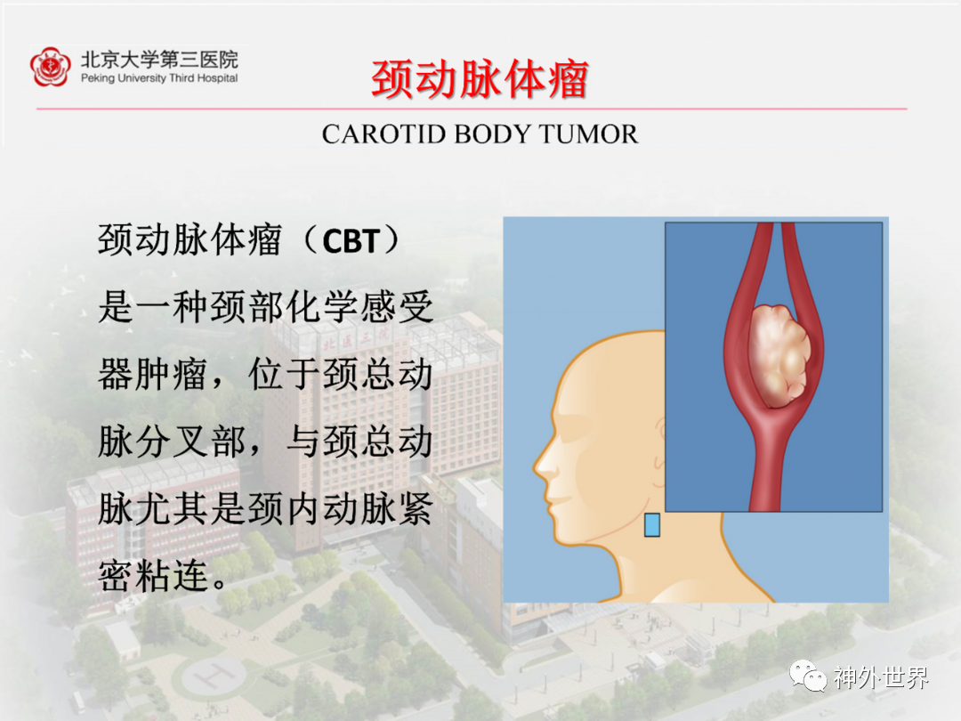 颈动脉体瘤位置图片图片