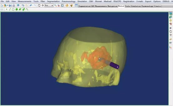 3D列印微創治療腦出血 科技 第3張