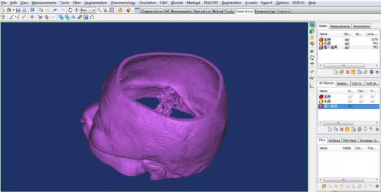 3D列印微創治療腦出血 科技 第2張