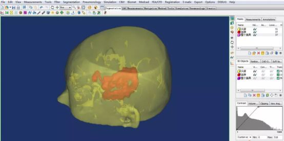 3D列印微創治療腦出血 科技 第1張