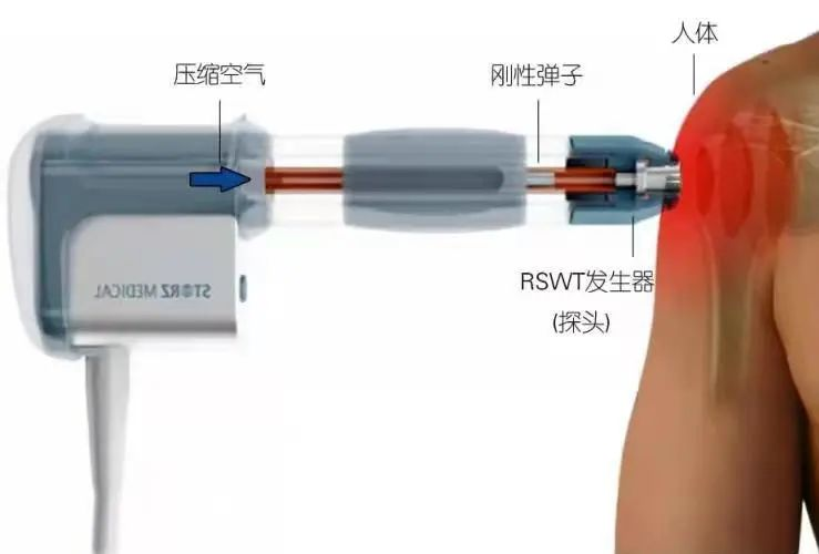 冲击波治疗是什么原理医科普：什么是冲击波治疗？_https://www.jmylbn.com_新闻资讯_第2张