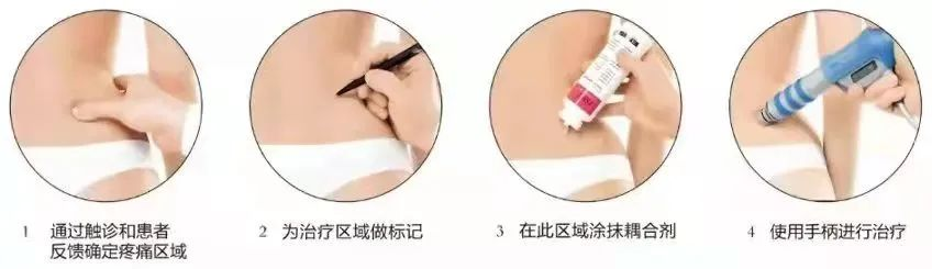 冲击波治疗是什么原理医科普：什么是冲击波治疗？_https://www.jmylbn.com_新闻资讯_第3张