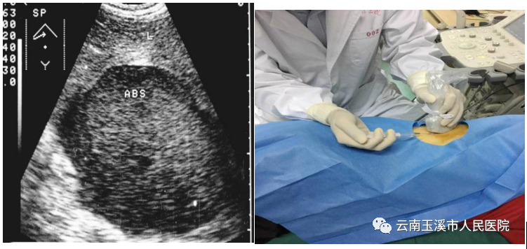 猪尾巴引流管是什么肝胆外科医生带你了解：经皮经肝穿刺置管引流术治疗肝脓肿_https://www.jmylbn.com_新闻资讯_第5张