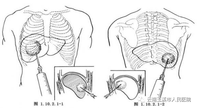 猪尾巴引流管是什么肝胆外科医生带你了解：经皮经肝穿刺置管引流术治疗肝脓肿_https://www.jmylbn.com_新闻资讯_第6张