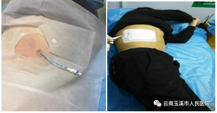 猪尾巴引流管是什么肝胆外科医生带你了解：经皮经肝穿刺置管引流术治疗肝脓肿_https://www.jmylbn.com_新闻资讯_第7张