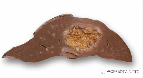 猪尾巴引流管是什么肝胆外科医生带你了解：经皮经肝穿刺置管引流术治疗肝脓肿_https://www.jmylbn.com_新闻资讯_第2张