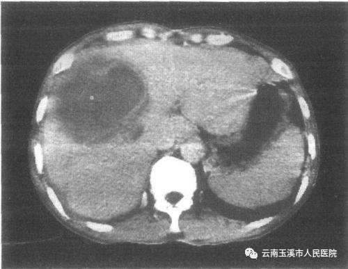 猪尾巴引流管是什么肝胆外科医生带你了解：经皮经肝穿刺置管引流术治疗肝脓肿_https://www.jmylbn.com_新闻资讯_第4张