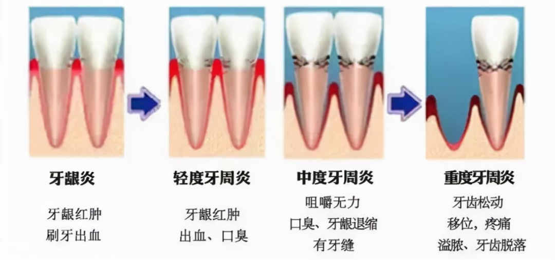 首页>口腔科普>科普图文>以下是牙周病的常见症状,您可以对照进行自查