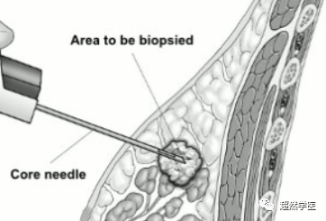 活检针怎么用空芯穿刺活检针的使用_https://www.jmylbn.com_新闻资讯_第6张