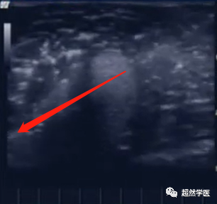 活检针怎么用空芯穿刺活检针的使用_https://www.jmylbn.com_新闻资讯_第8张