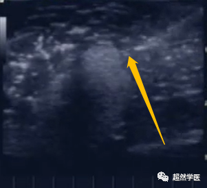 活检针怎么用空芯穿刺活检针的使用_https://www.jmylbn.com_新闻资讯_第7张