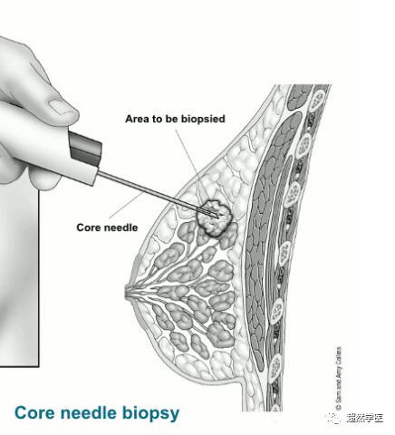 活检针怎么用空芯穿刺活检针的使用_https://www.jmylbn.com_新闻资讯_第3张