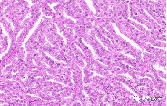 fh染色是什么意思WHO2022年分类：乳头状肾细胞癌进展介绍_https://www.jmylbn.com_新闻资讯_第1张