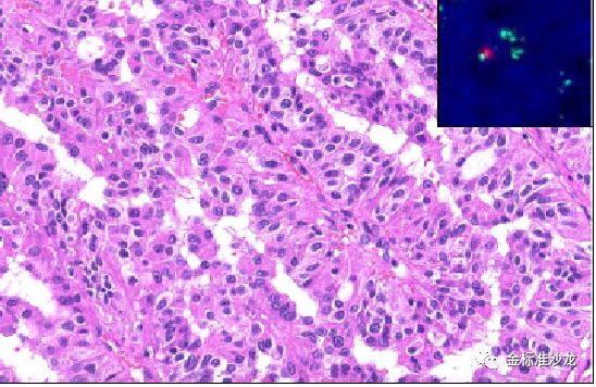 fh染色是什么意思WHO2022年分类：乳头状肾细胞癌进展介绍_https://www.jmylbn.com_新闻资讯_第3张