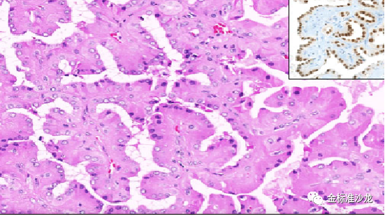 fh染色是什么意思WHO2022年分类：乳头状肾细胞癌进展介绍_https://www.jmylbn.com_新闻资讯_第6张