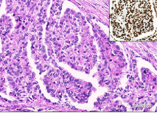 fh染色是什么意思WHO2022年分类：乳头状肾细胞癌进展介绍_https://www.jmylbn.com_新闻资讯_第2张