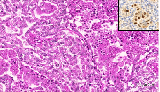 fh染色是什么意思WHO2022年分类：乳头状肾细胞癌进展介绍_https://www.jmylbn.com_新闻资讯_第4张
