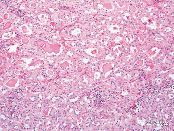 fh染色是什么意思WHO2022年分类：乳头状肾细胞癌进展介绍_https://www.jmylbn.com_新闻资讯_第8张