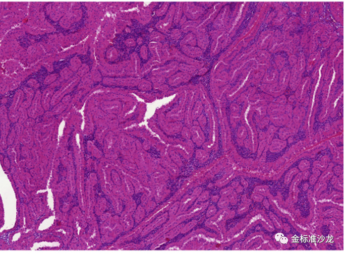 fh染色是什么意思WHO2022年分类：乳头状肾细胞癌进展介绍_https://www.jmylbn.com_新闻资讯_第7张
