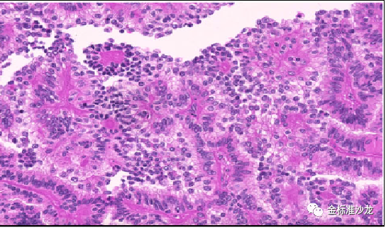 fh染色是什么意思WHO2022年分类：乳头状肾细胞癌进展介绍_https://www.jmylbn.com_新闻资讯_第5张