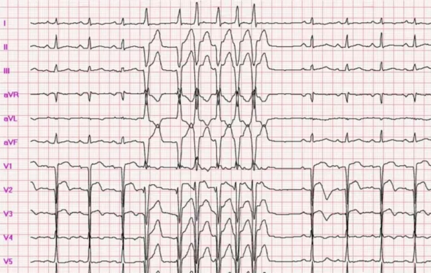 阵发性室上性心动过速图片