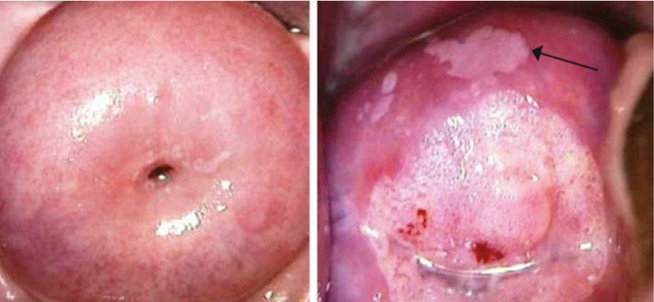 刮匙怎么使用HPV疫苗打完就安全了吗？男生要打吗？几岁打最有用？一文讲清_https://www.jmylbn.com_新闻资讯_第11张