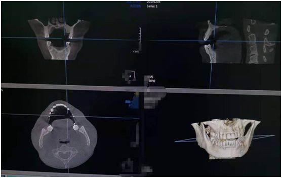 口腔ct怎么拍摄新设备 ｜ 我院最新引进了韩国高品质口腔CT_https://www.jmylbn.com_新闻资讯_第5张