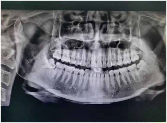 口腔ct怎么拍摄新设备 ｜ 我院最新引进了韩国高品质口腔CT_https://www.jmylbn.com_新闻资讯_第4张