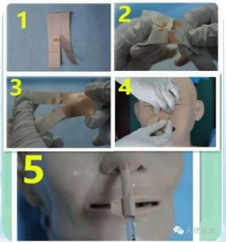 怎么拔鼻腔引流管胃管术（二）_https://www.jmylbn.com_新闻资讯_第10张