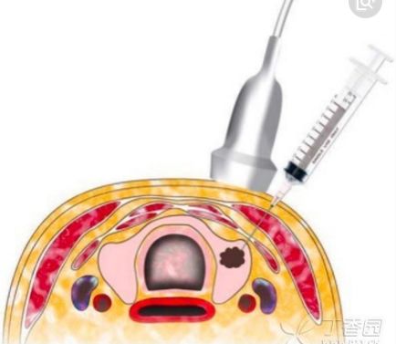 穿刺枪怎么升级乳腺穿刺术（三）_https://www.jmylbn.com_新闻资讯_第81张