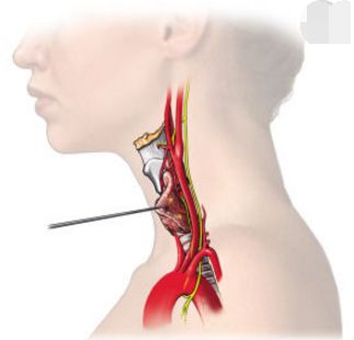 穿刺枪怎么升级乳腺穿刺术（三）_https://www.jmylbn.com_新闻资讯_第78张