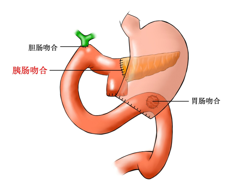 胰十二指肠吻合口图图片