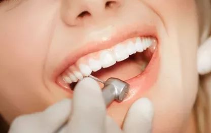 牙齿贴面会不会导致嘴凸？真相竟然是这样的....