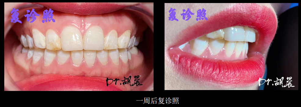 为什么牙医不用开口器特邀牙医【实操病例】集锦{9.22}_https://www.jmylbn.com_新闻资讯_第7张