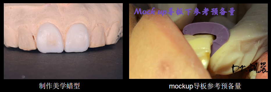 为什么牙医不用开口器特邀牙医【实操病例】集锦{9.22}_https://www.jmylbn.com_新闻资讯_第2张