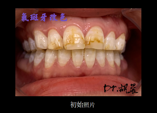 为什么牙医不用开口器特邀牙医【实操病例】集锦{9.22}_https://www.jmylbn.com_新闻资讯_第1张