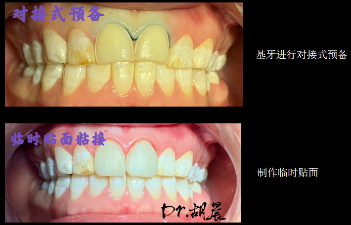 为什么牙医不用开口器特邀牙医【实操病例】集锦{9.22}_https://www.jmylbn.com_新闻资讯_第3张